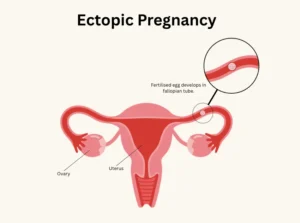 Ectopic Pregnancy Post-IVF with TCM