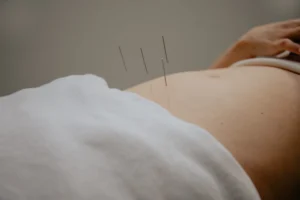 Patient receiving abdominal fertility acupuncture to support IVF Age Limit Singapore treatments.